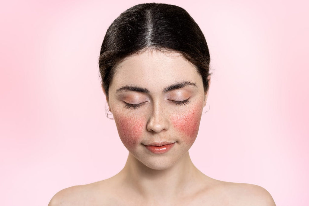Hudpleie mot Rosacea - Nyhud.no