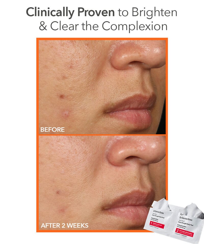 Dr. Dennis Gross Peeling Dr. Dennis gross Alpha Beta® Face Peel Extra Strength -Servietter 5 pack