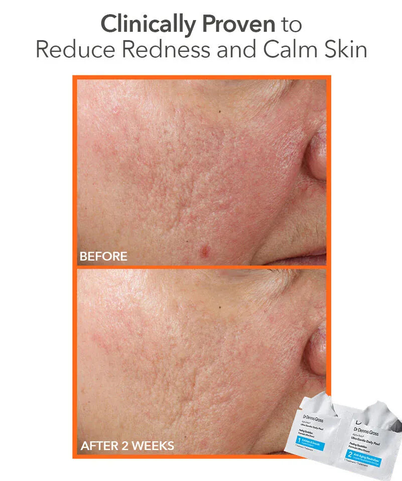 Dr. Dennis Gross Peeling Dr. Dennis Gross Alpha Beta® Face Peel Ultra Gentle -Servietter 5 pack